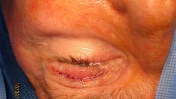 Skin incision closed after gold weight implantation