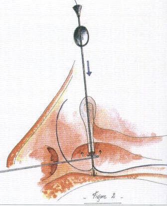 Layered eyelid laceration repair
