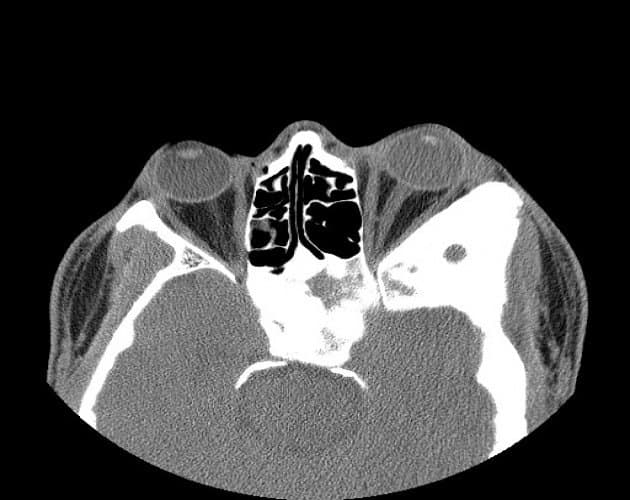 CT scan β fibrous dysplasia expanding the orbital bone, with the characteristic hazy βground-glassβ matrix
