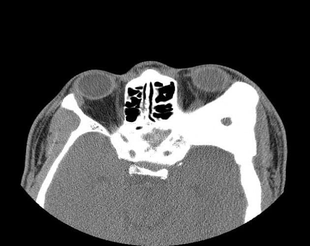 CT of orbital fibrous dysplasia β expanded ground-glass bone
