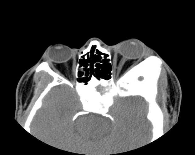 CT of orbital fibrous dysplasia β bony reshaping of the orbit