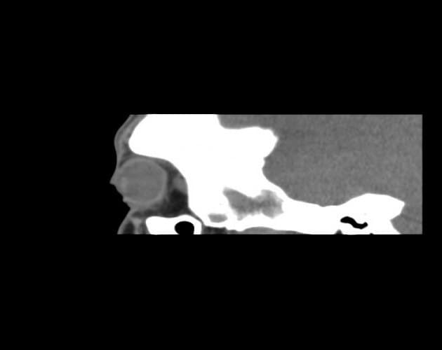 CT β ground-glass expansion of orbital bone characteristic of fibrous dysplasia