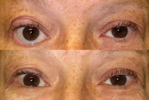 Right lower-eyelid retraction from thyroid eye disease, corrected with a posterior spacer graft (TarSys)