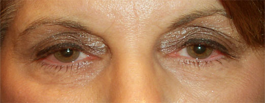 Before treatment — Ptosis Repair · Age 53