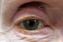Photograph of Canaliculitis on the Right Lower Eyelid