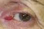 Photograph showing Canaliculitis on the left upper eyelid.